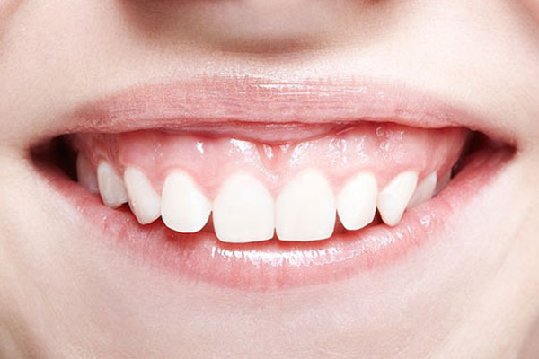 Cười hở lợi là gì?