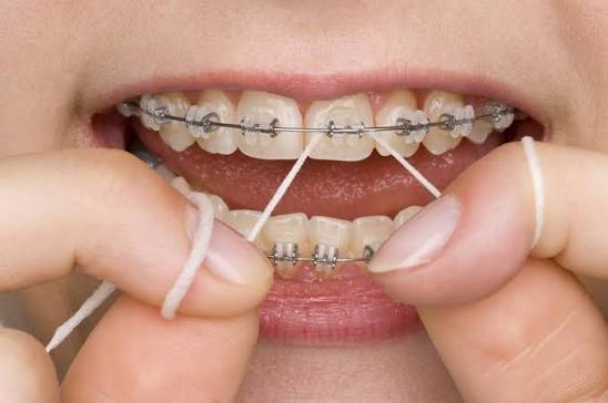 Những lỗi thường gặp khi vệ sinh răng niềng