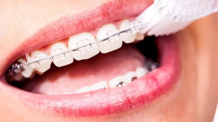 Vì sao cần vệ sinh răng kỹ khi niềng?