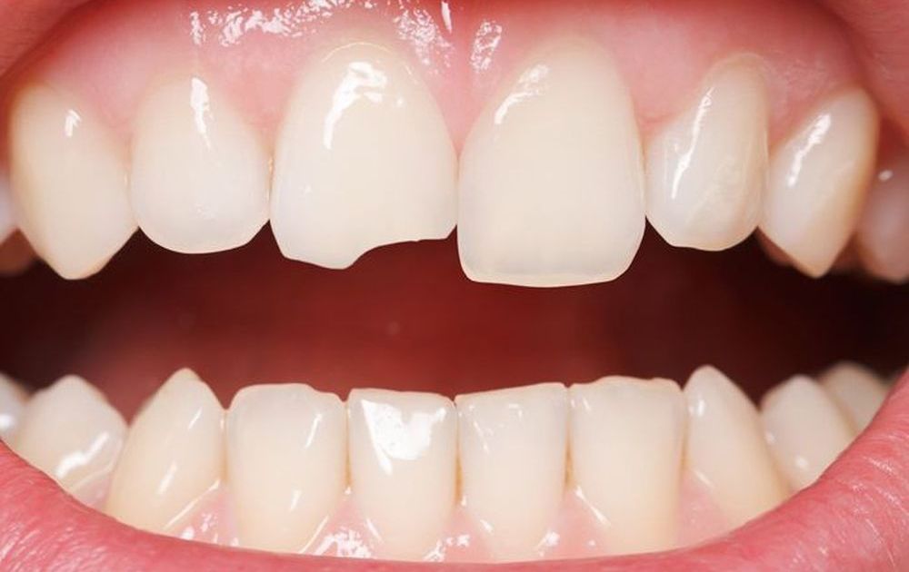 Răng bị mẻ, gãy vỡ có cần điều trị không?
