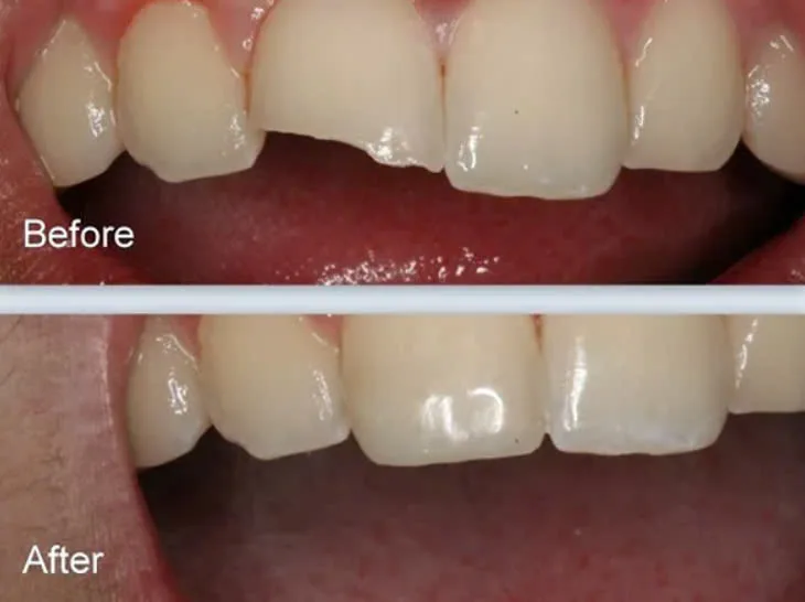 Dấu hiệu nào cần phục hồi răng sớm?