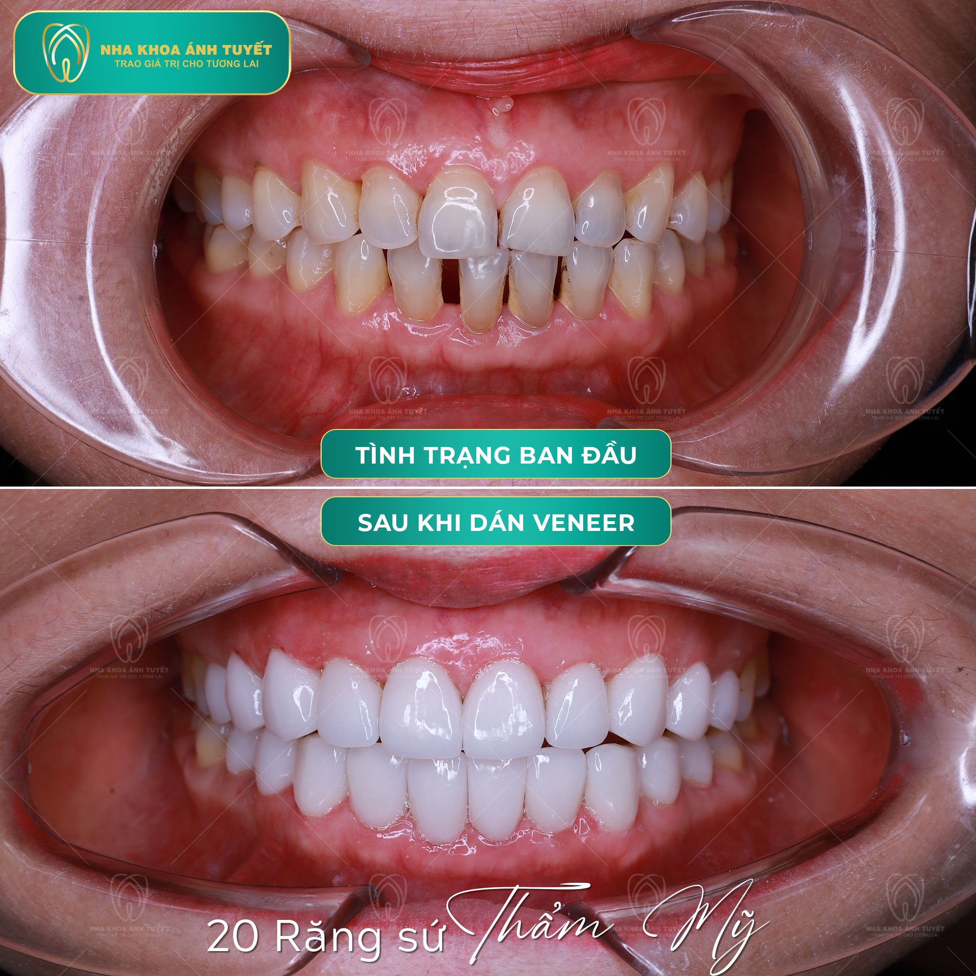 Nụ Cười Thẩm Mỹ Với Răng Sứ Veneer
