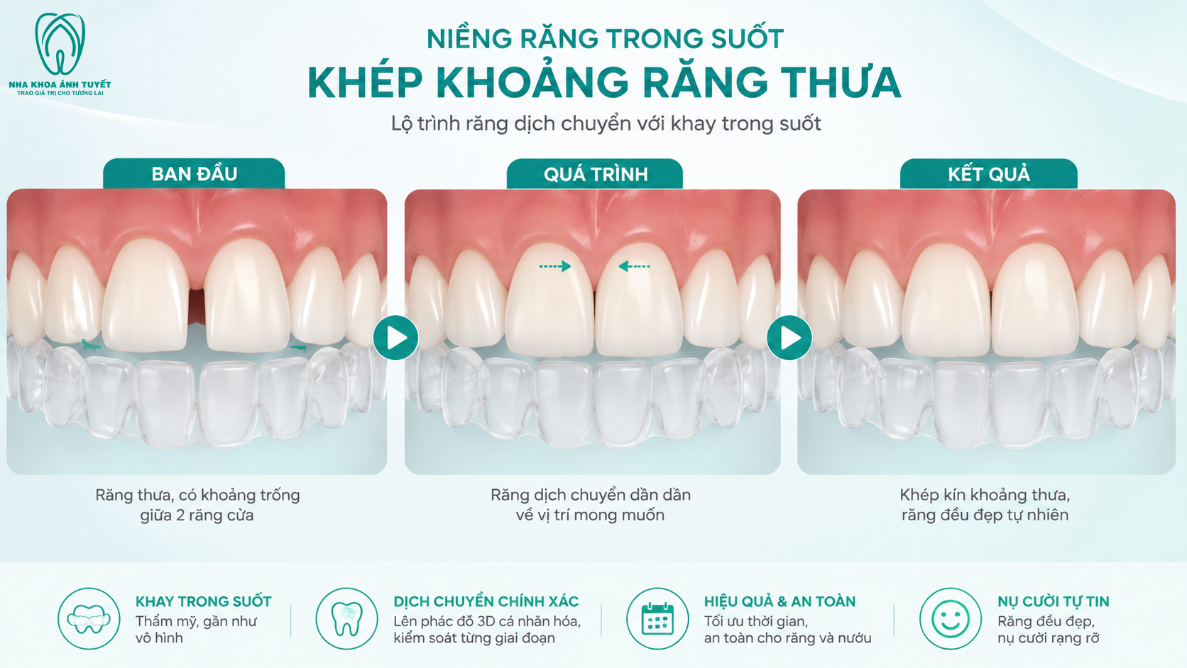 Hình ảnh mô phỏng quá trình niềng răng dịch chuyển răng sát lại gần nhau