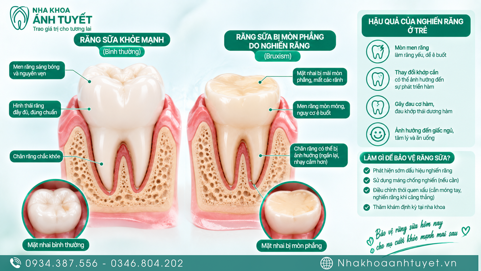 Hình ảnh so sánh bề mặt răng sữa bình thường và răng sữa bị mòn do nghiến