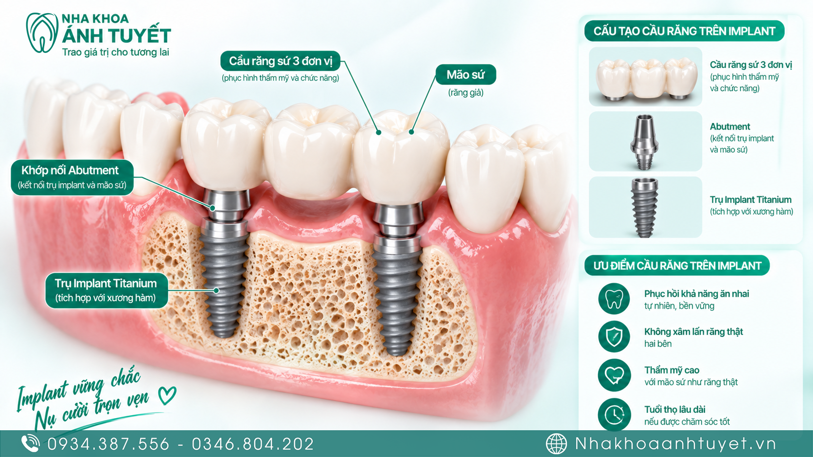 Mô phỏng 3D cầu răng sứ đặt trên 2 trụ implant nâng đỡ
