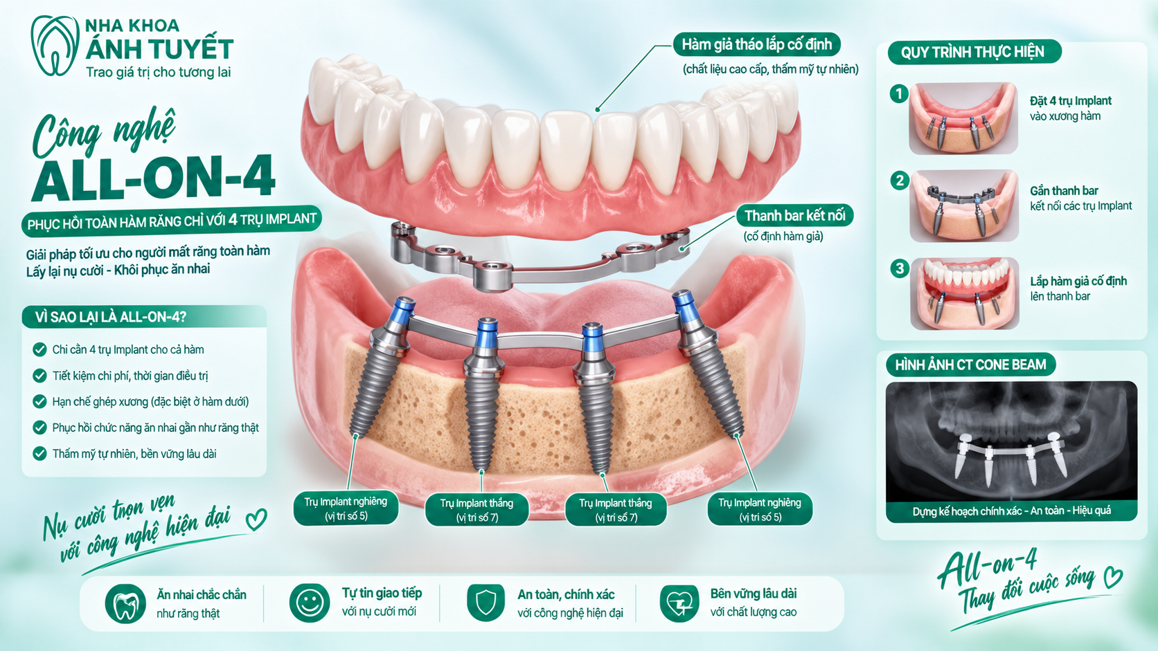 Kỹ thuật cấy implant cho hàm mất nhiều răng công nghệ All-on-4 và All-on-6