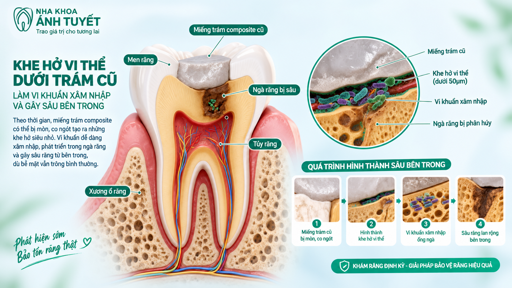Mô phỏng 3D vi khuẩn xâm nhập gây sâu răng tái phát dưới miếng trám co ngót