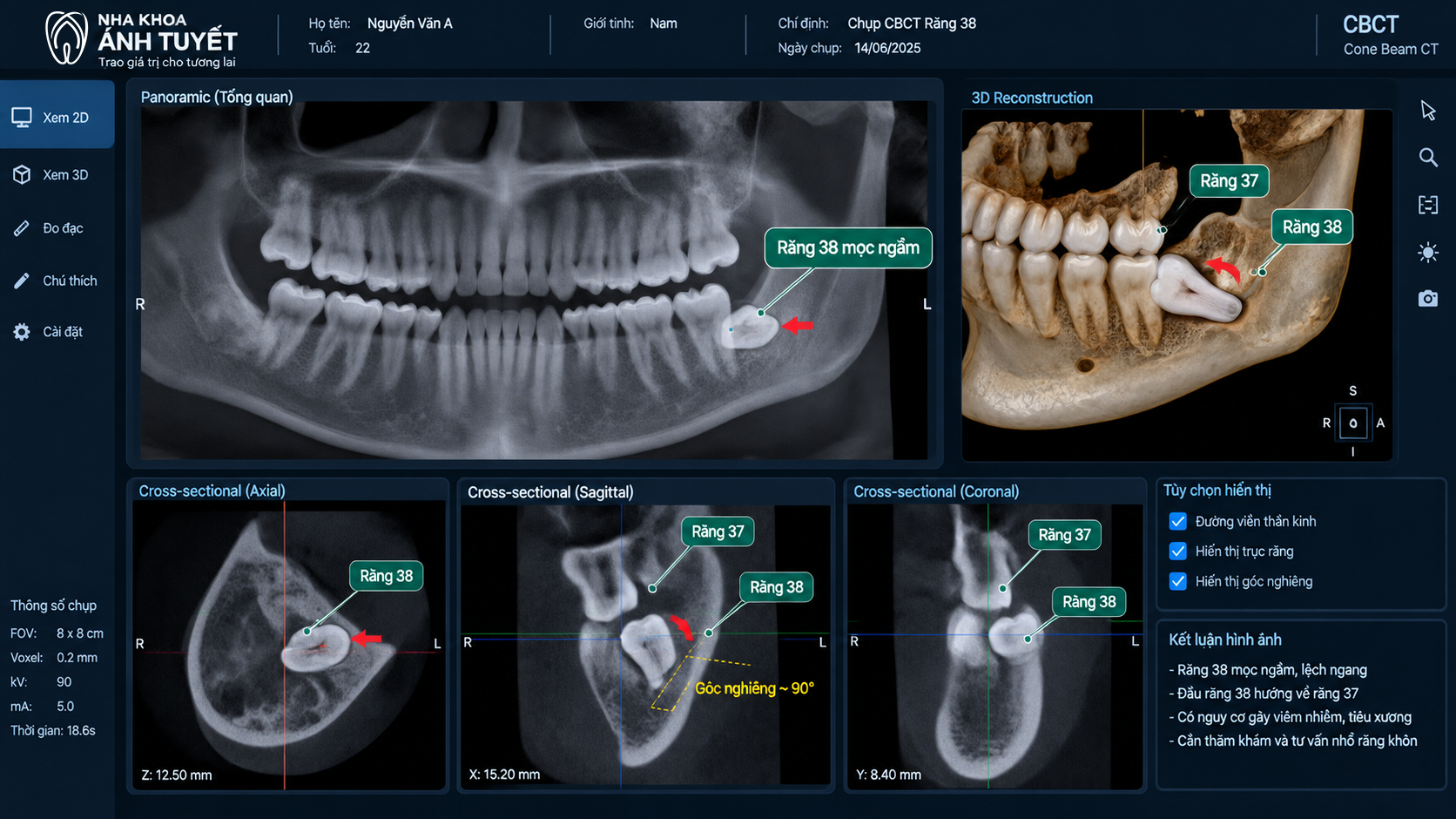 Phim chụp X-quang 3D khảo sát hướng mọc răng khôn để đưa ra phác đồ điều trị viêm lợi trùm