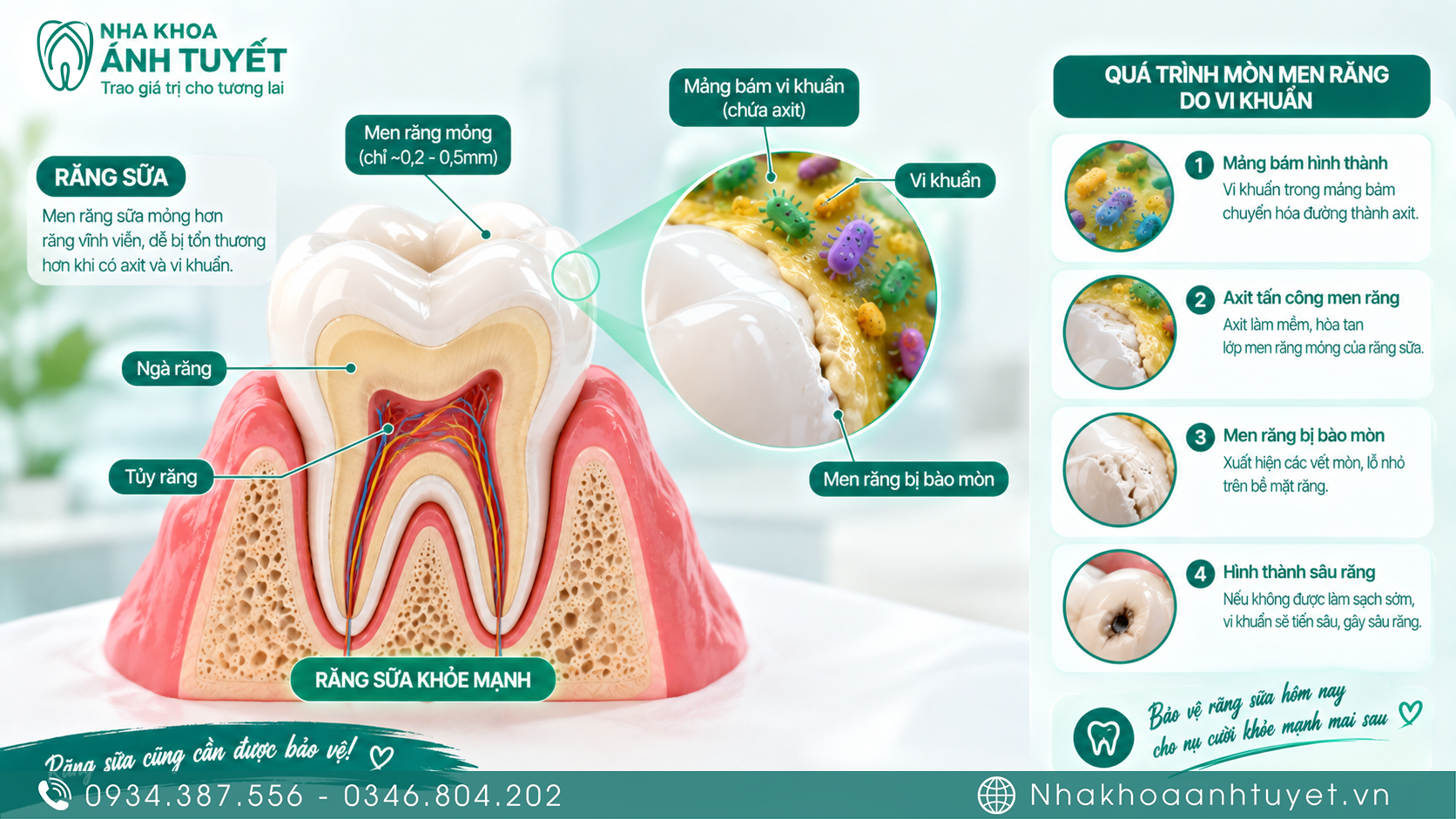 Hình ảnh mô phỏng cấu trúc men răng sữa mỏng yếu khi trẻ bị sún răng