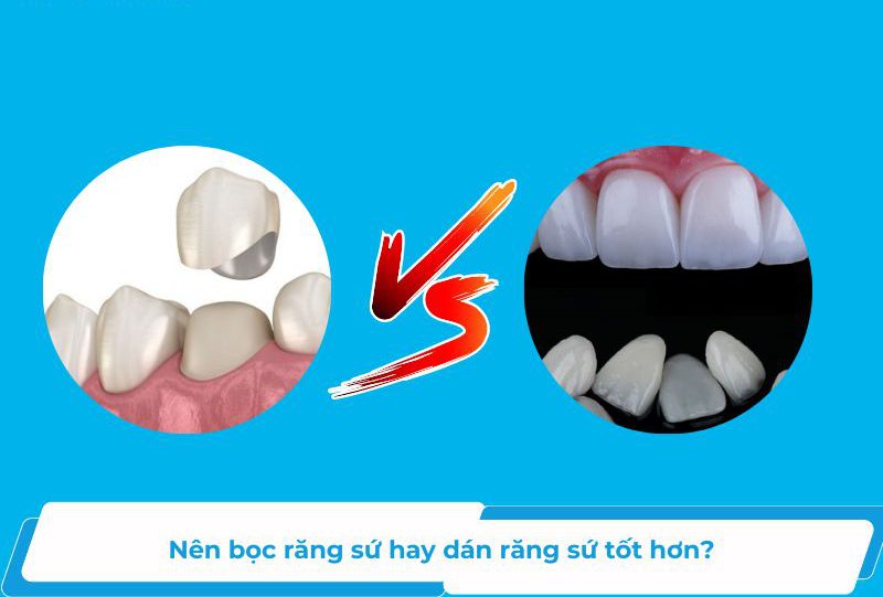 Nên bọc răng sứ hay dán sứ veneer