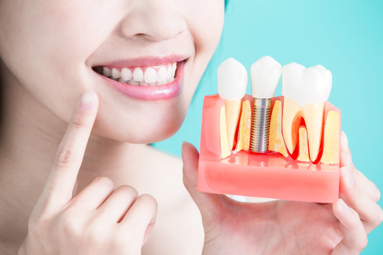 cấy implant có đau không