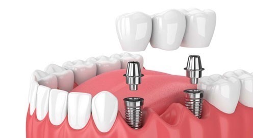 cấy implant tại tiền hải