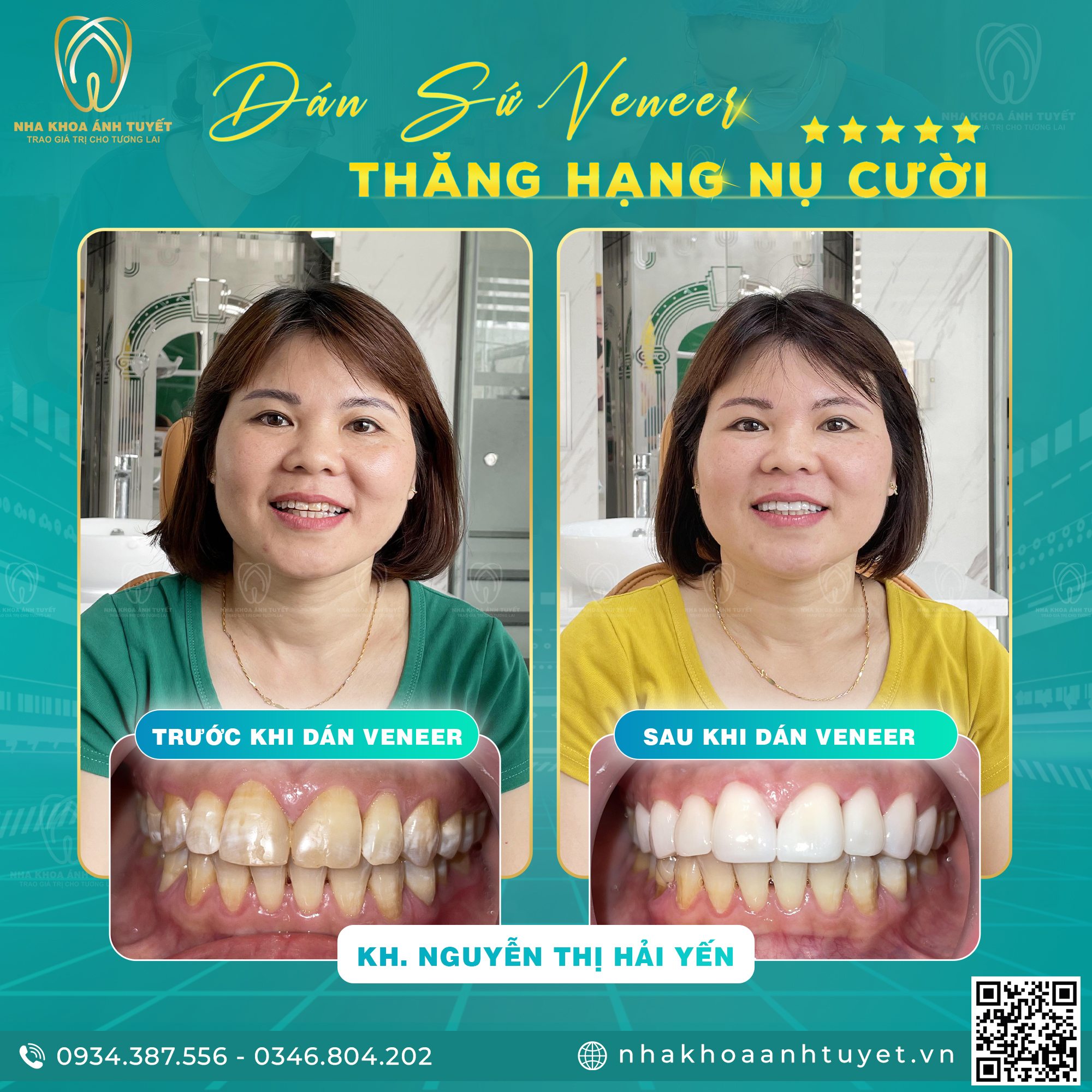 Thẩm mỹ răng sứ uy tín tại Tiền Hải, Thái Bình