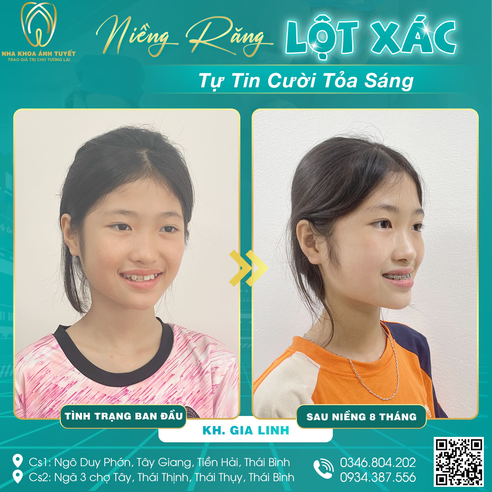 niềng răng ở tiền hải