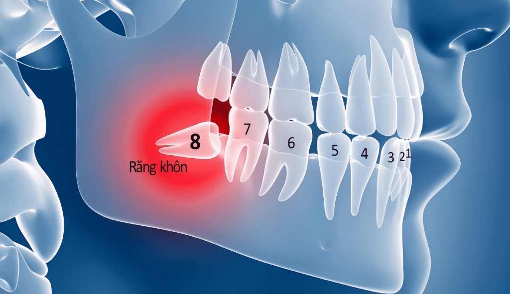 răng khôn là gì
