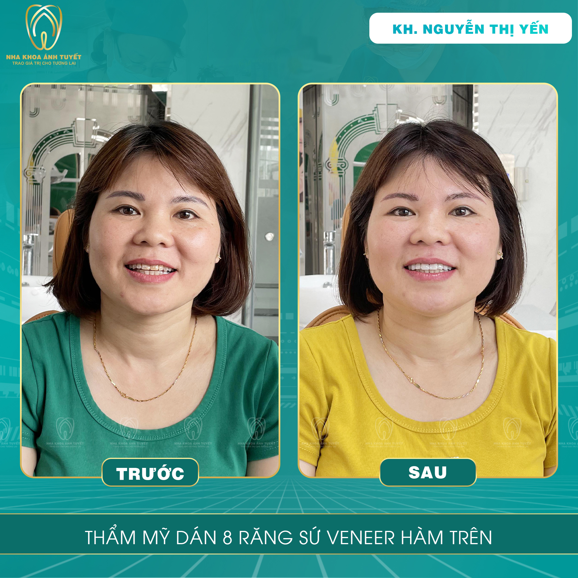 Dán sứ thẩm mỹ uy tín tại Tiền Hải