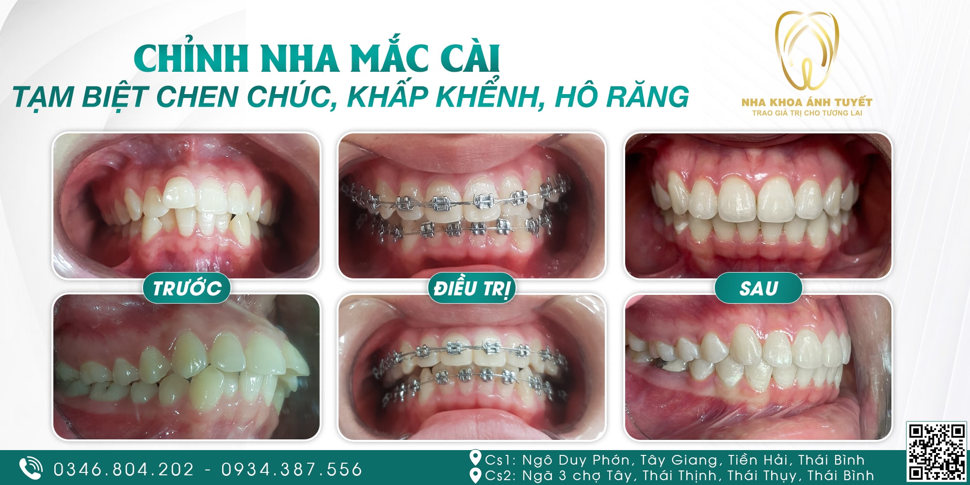 Niềng răng tại Nha Khoa Ánh Tuyết Tiền Hải, Thái Thụy - Thái Bình