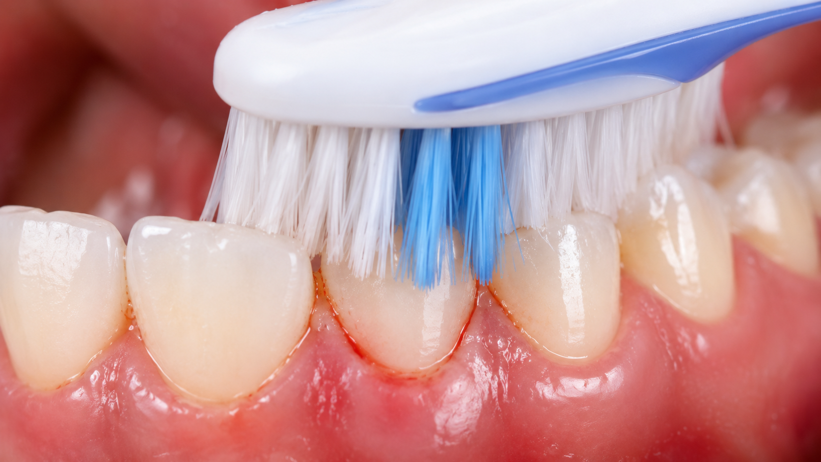 Chảy máu chân răng là biểu hiện của viêm nướu giai đoạn 1