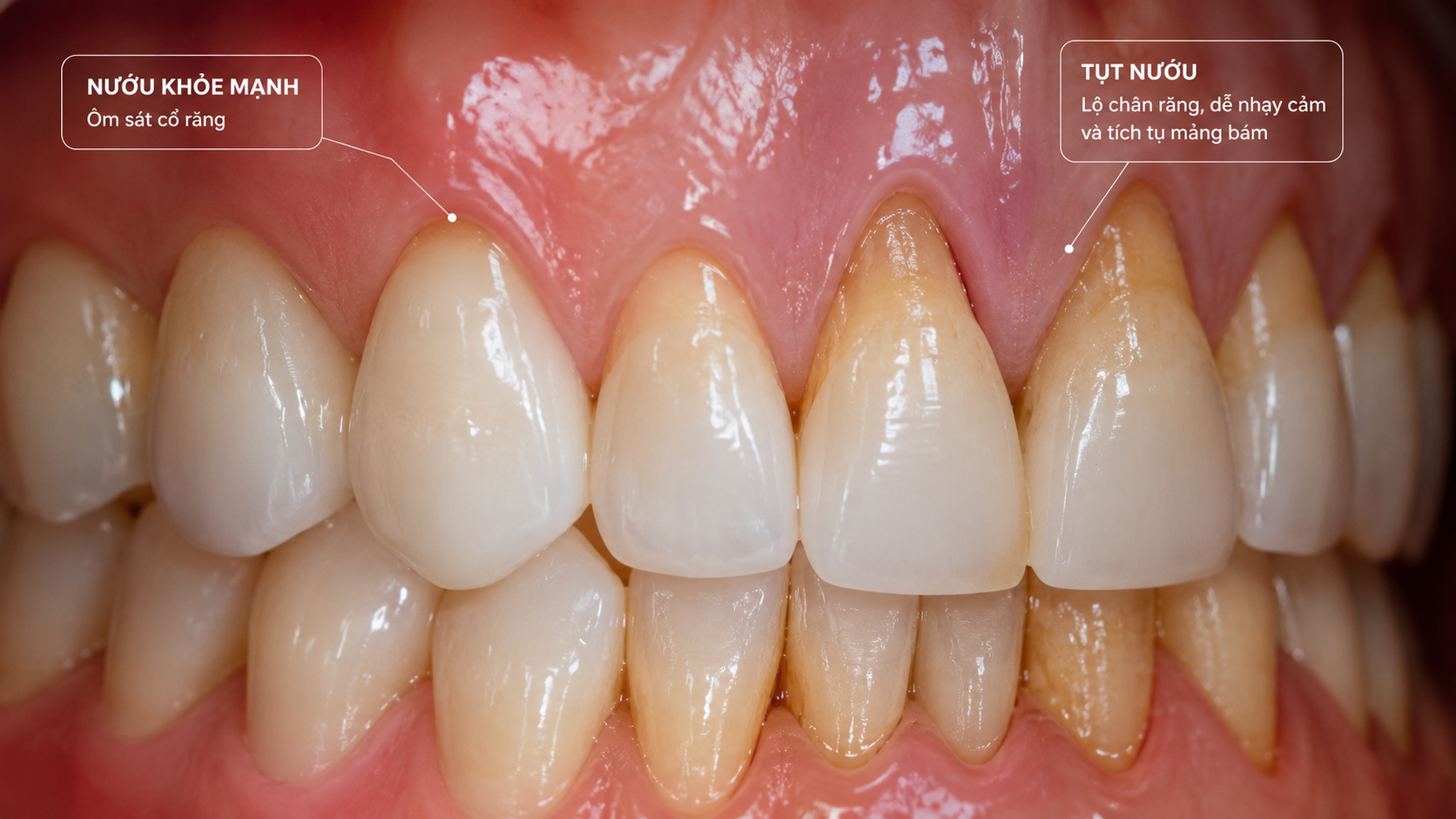 Tình trạng tụt nướu răng khiến chân răng bị hở và dài ra bất thường