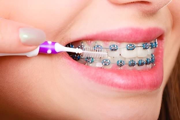 Hướng dẫn vệ sinh răng niềng đúng cách