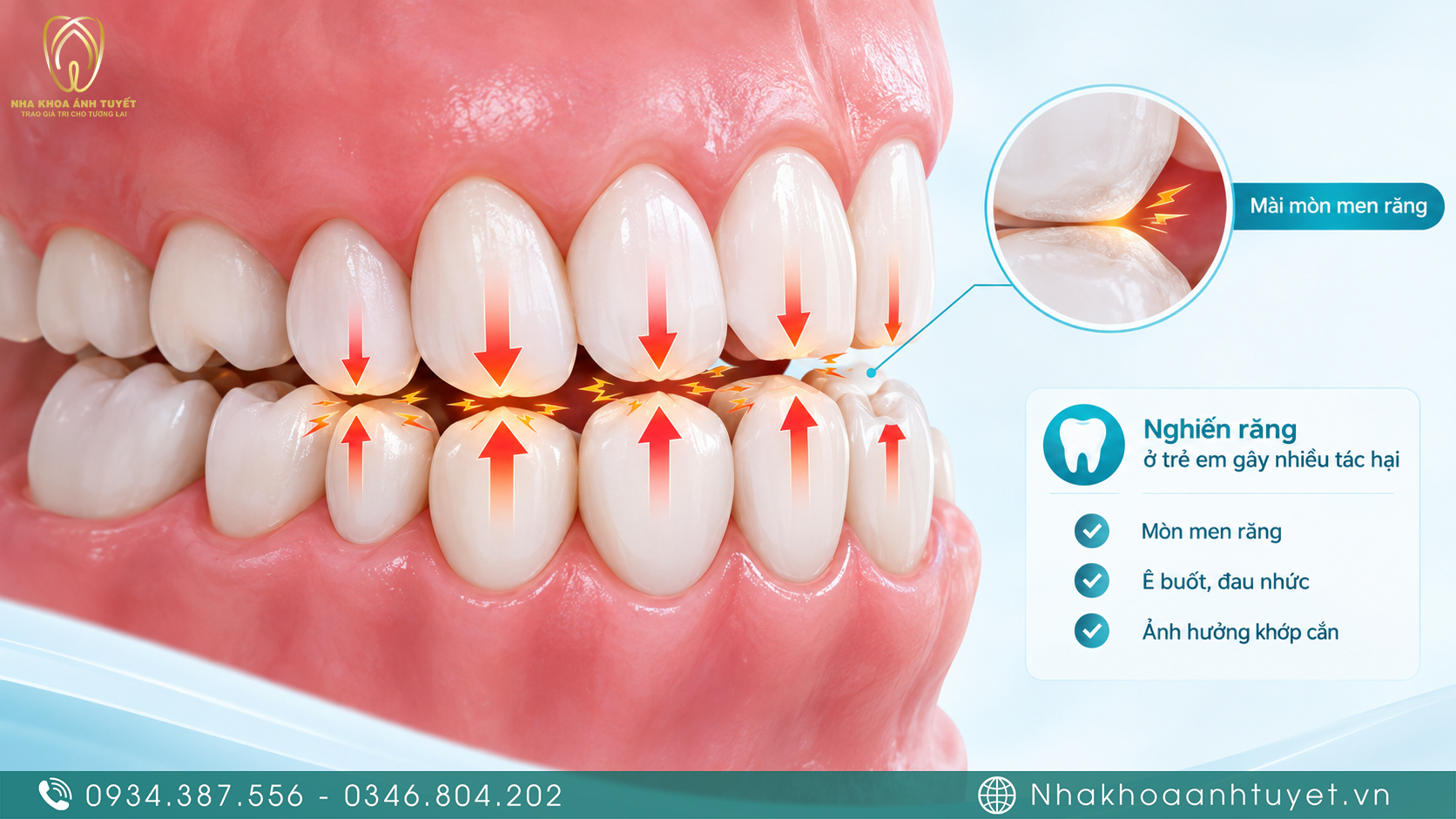 Hình ảnh minh họa cấu trúc răng sữa của trẻ bị chà xát khi nghiến