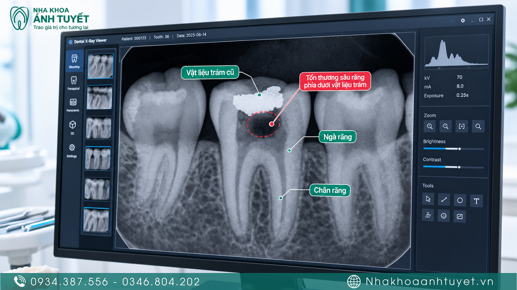 Phim X-quang nha khoa phát hiện ổ sâu răng tái phát dưới miếng trám trám cũ