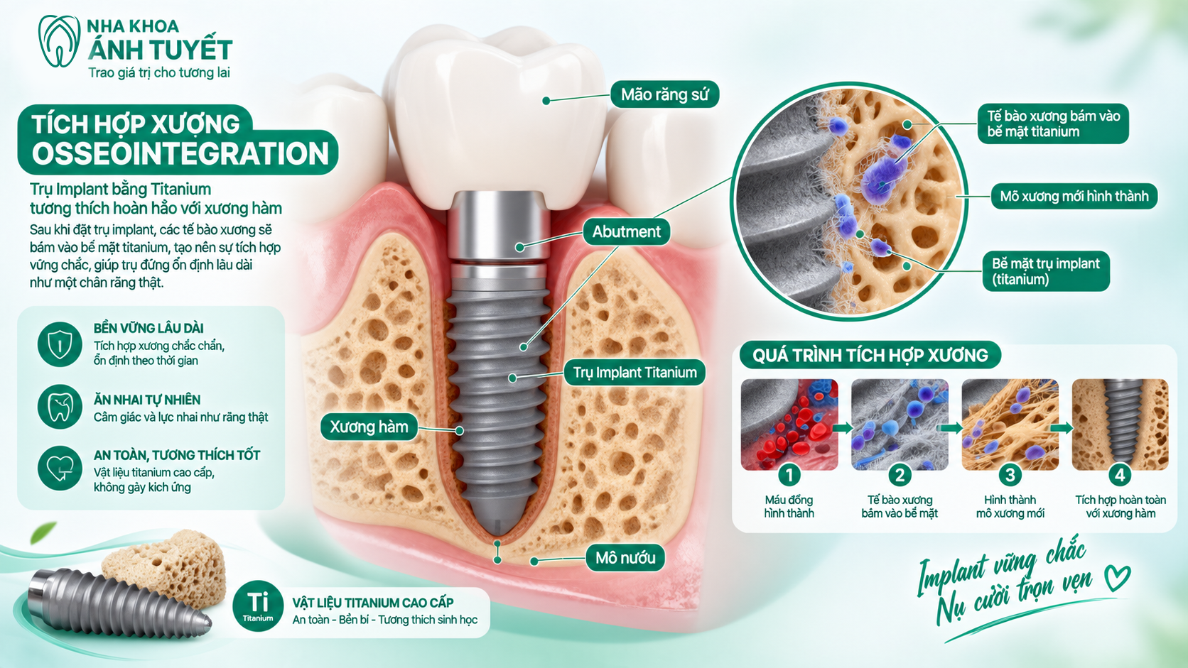 Cấy Ghép Implant Là Gì?